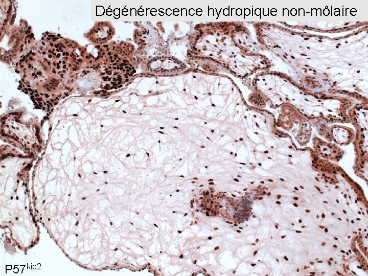 Dégénérescence hydropique non-môlaire P 57 kip 2 