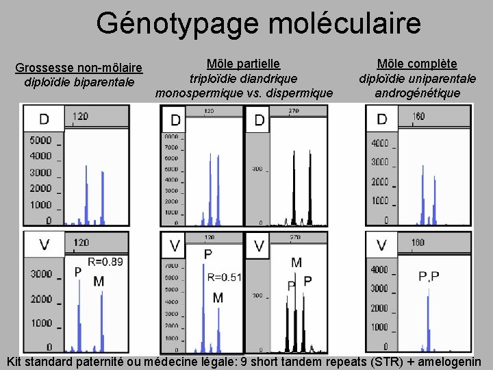 Génotypage moléculaire Grossesse non-môlaire diploïdie biparentale Môle partielle triploïdie diandrique monospermique vs. dispermique Môle