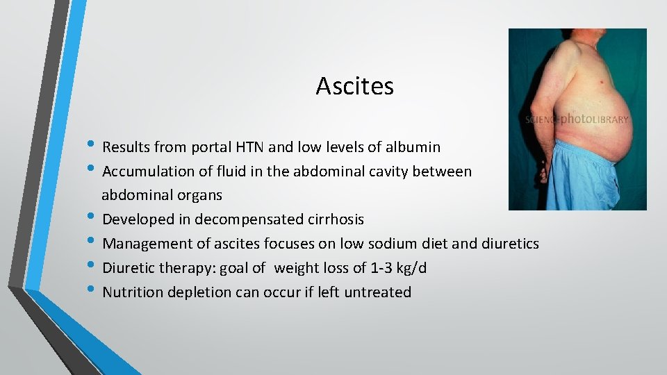 Ascites • Results from portal HTN and low levels of albumin • Accumulation of