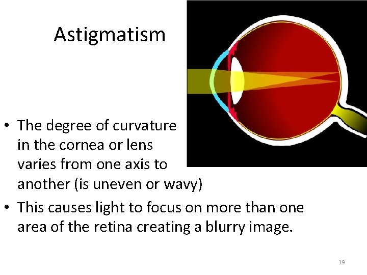 Astigmatism • The degree of curvature in the cornea or lens varies from one