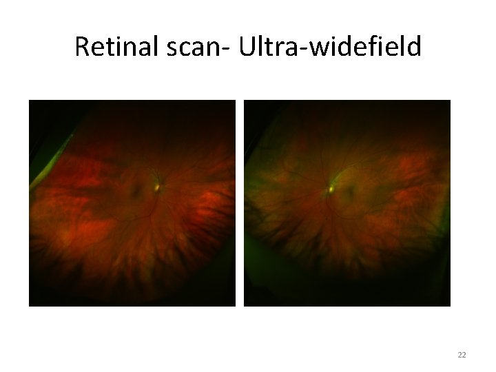 Retinal scan- Ultra-widefield 22 