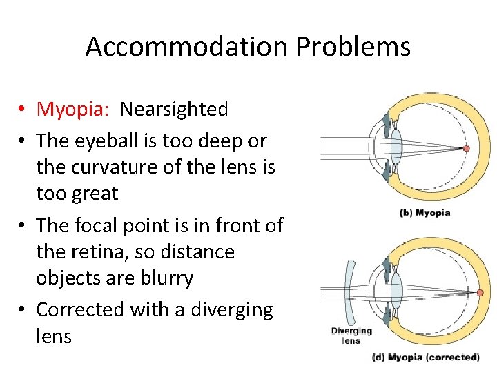 Accommodation Problems • Myopia: Nearsighted • The eyeball is too deep or the curvature