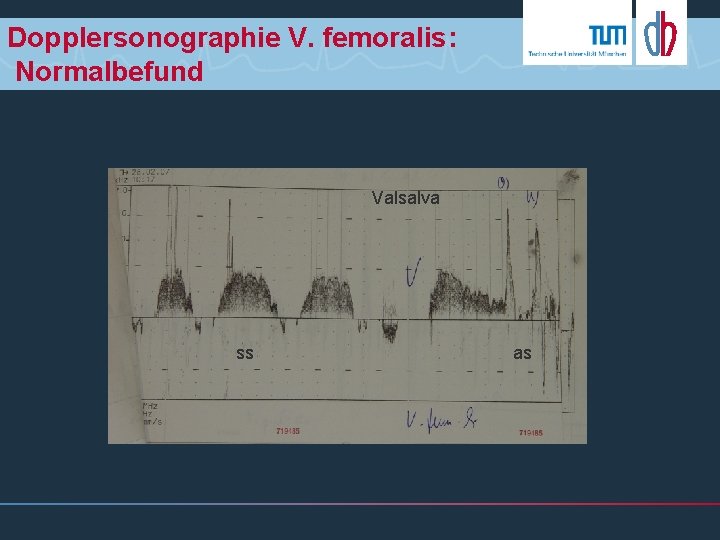 Dopplersonographie V. femoralis: Normalbefund Valsalva ss as 