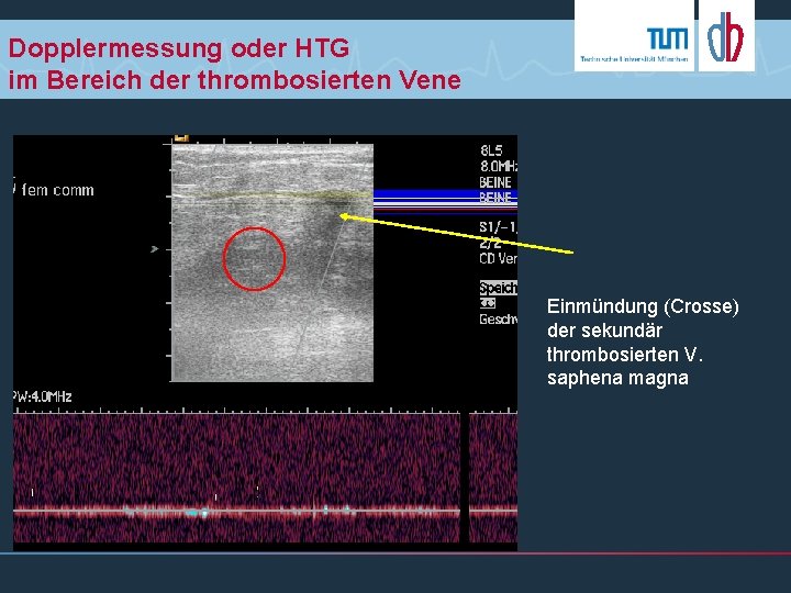 Dopplermessung oder HTG im Bereich der thrombosierten Vene Einmündung (Crosse) der sekundär thrombosierten V.