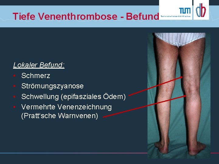 Tiefe Venenthrombose - Befund Lokaler Befund: • Schmerz • Strömungszyanose • Schwellung (epifasziales Ödem)