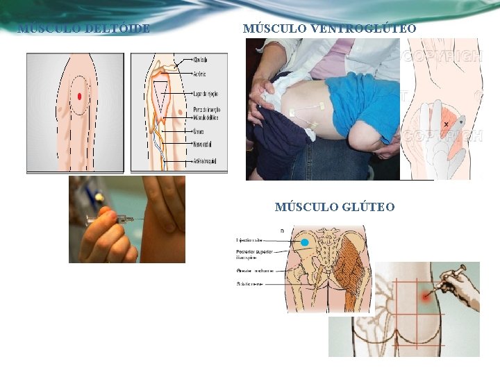 MÚSCULO DELTÓIDE MÚSCULO VENTROGLÚTEO MÚSCULO GLÚTEO 