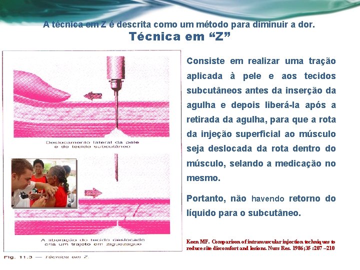 A técnica em Z é descrita como um método para diminuir a dor. Técnica