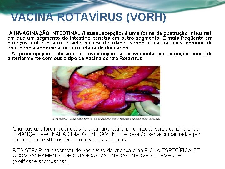 VACINA ROTAVÍRUS (VORH) A INVAGINAÇÃO INTESTINAL (intussuscepção) é uma forma de obstrução intestinal, em