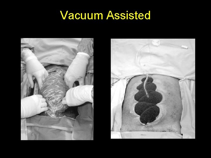 Vacuum Assisted 