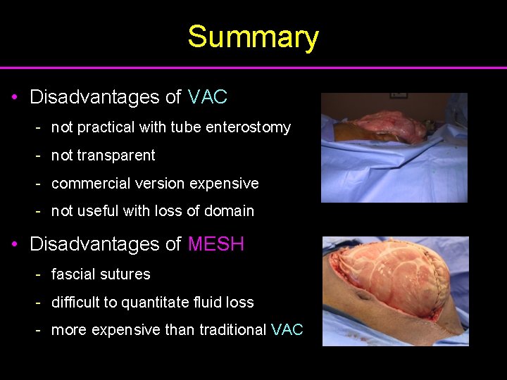 Summary • Disadvantages of VAC - not practical with tube enterostomy - not transparent