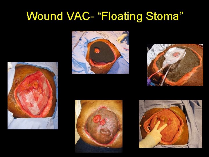 Wound VAC- “Floating Stoma” 