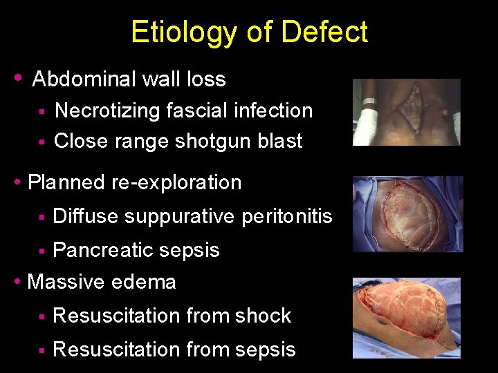 Etiology of Defect • Abdominal wall loss Necrotizing fascial infection § Close range shotgun