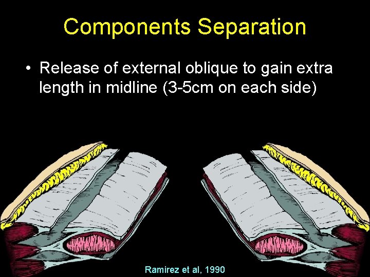 Components Separation • Release of external oblique to gain extra length in midline (3