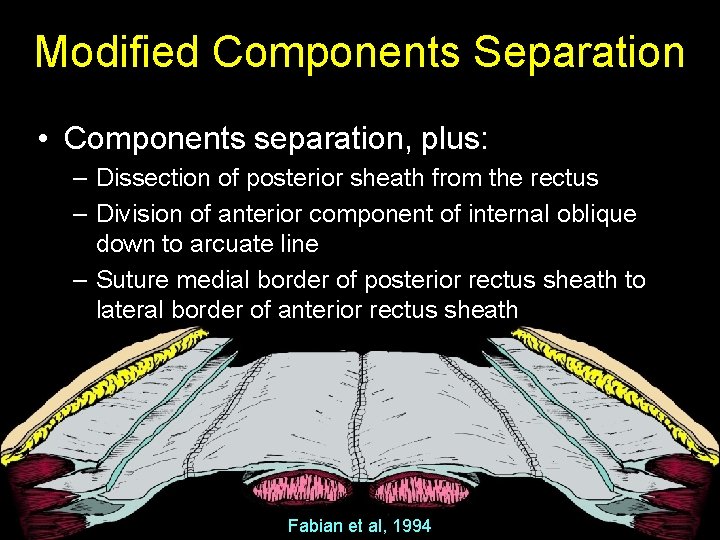 Modified Components Separation • Components separation, plus: – Dissection of posterior sheath from the