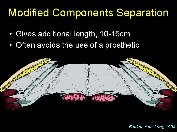 Modified Components Separation • Gives additional length, 10 -15 cm • Often avoids the