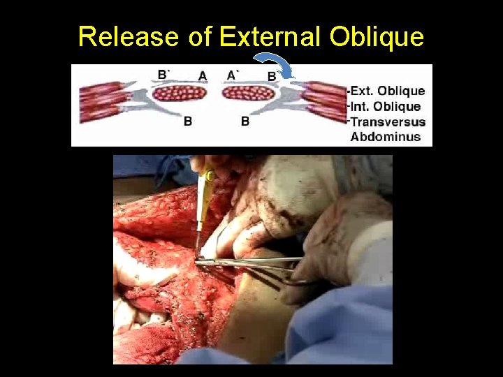 Release of External Oblique 