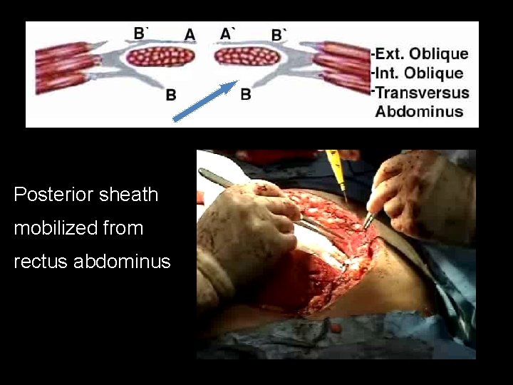 Posterior sheath mobilized from rectus abdominus 