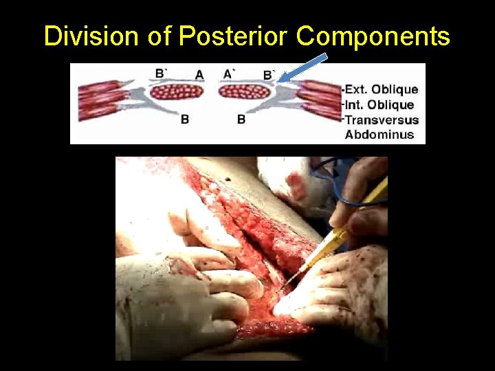 Division of Posterior Components 