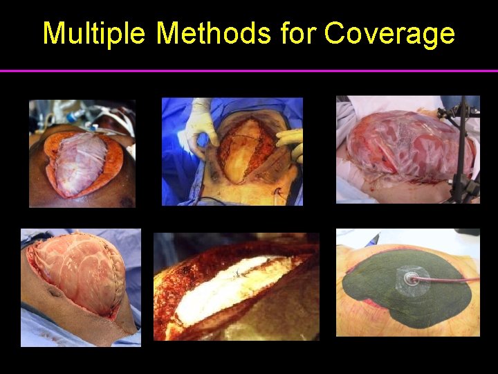 Multiple Methods for Coverage 