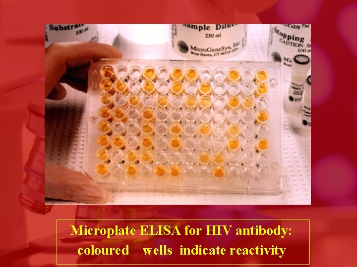 Microplate ELISA for HIV antibody: coloured wells indicate reactivity 