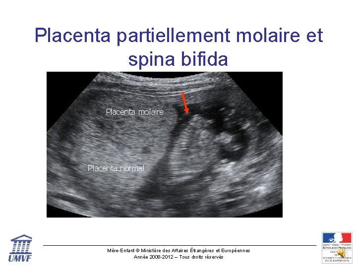 Placenta partiellement molaire et spina bifida Placenta molaire Placenta normal Mère-Enfant © Ministère des