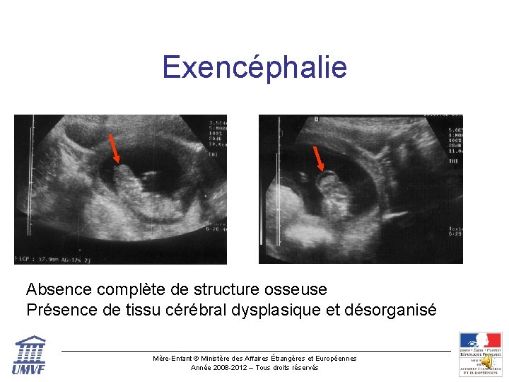 Exencéphalie Absence complète de structure osseuse Présence de tissu cérébral dysplasique et désorganisé Mère-Enfant