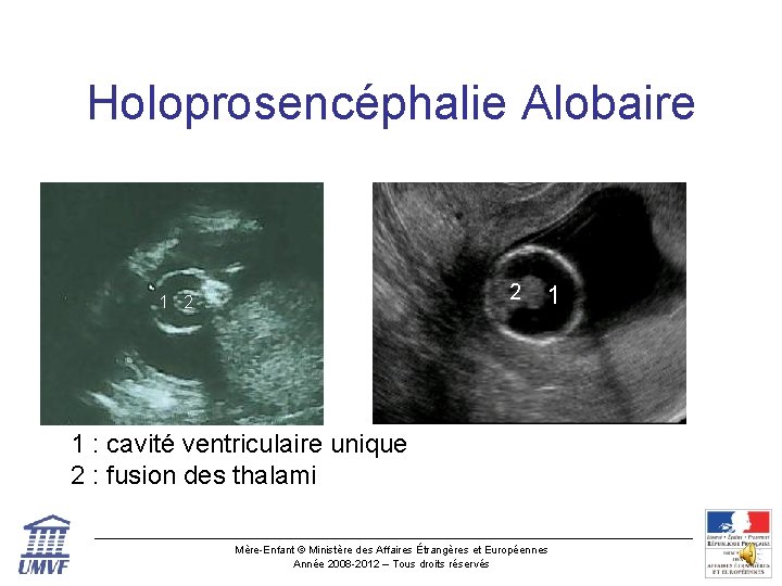 Holoprosencéphalie Alobaire 2 1 1 : cavité ventriculaire unique 2 : fusion des thalami