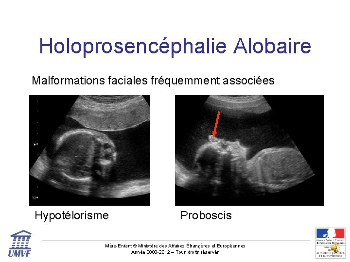 Holoprosencéphalie Alobaire Malformations faciales fréquemment associées Hypotélorisme Proboscis Mère-Enfant © Ministère des Affaires Étrangères