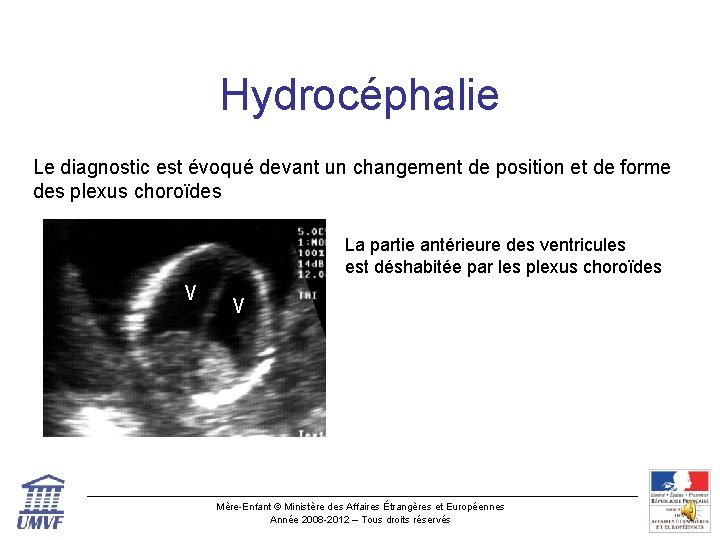 Hydrocéphalie Le diagnostic est évoqué devant un changement de position et de forme des
