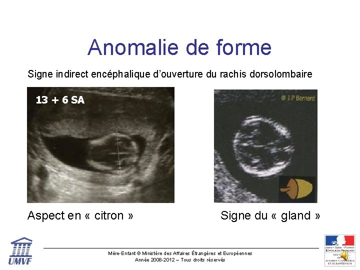 Anomalie de forme Signe indirect encéphalique d’ouverture du rachis dorsolombaire 13 + 6 SA