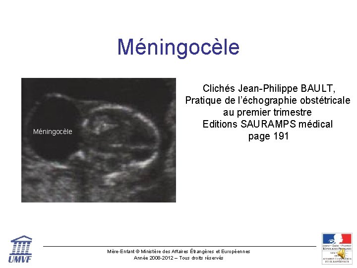 Méningocèle Clichés Jean-Philippe BAULT, Pratique de l’échographie obstétricale au premier trimestre Editions SAURAMPS médical