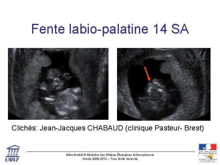 Fente labio-palatine 14 SA Clichés: Jean-Jacques CHABAUD (clinique Pasteur- Brest) Mère-Enfant © Ministère des
