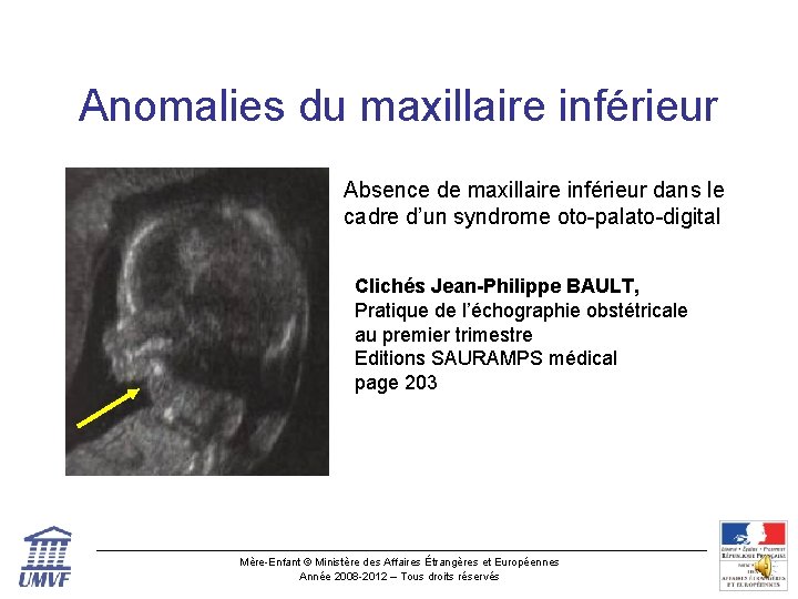 Anomalies du maxillaire inférieur Absence de maxillaire inférieur dans le cadre d’un syndrome oto-palato-digital