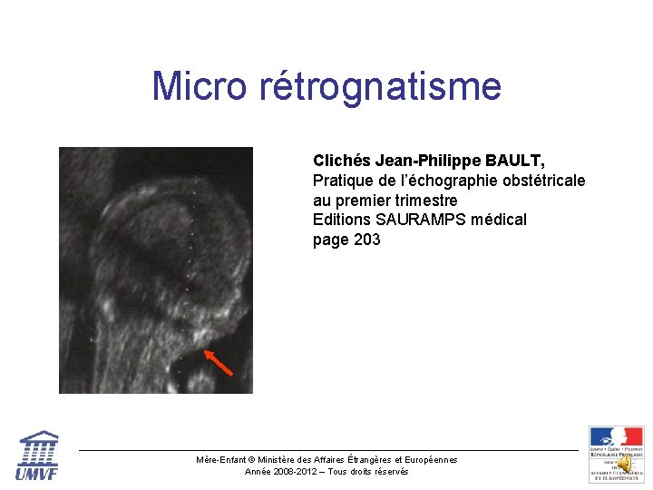 Micro rétrognatisme Clichés Jean-Philippe BAULT, Pratique de l’échographie obstétricale au premier trimestre Editions SAURAMPS