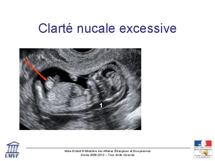 Clarté nucale excessive 1 Mère-Enfant © Ministère des Affaires Étrangères et Européennes Année 2008