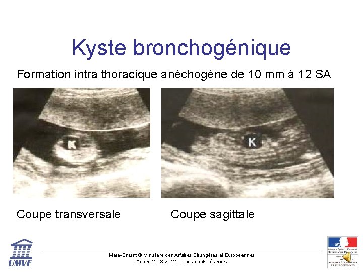 Kyste bronchogénique Formation intra thoracique anéchogène de 10 mm à 12 SA Coupe transversale