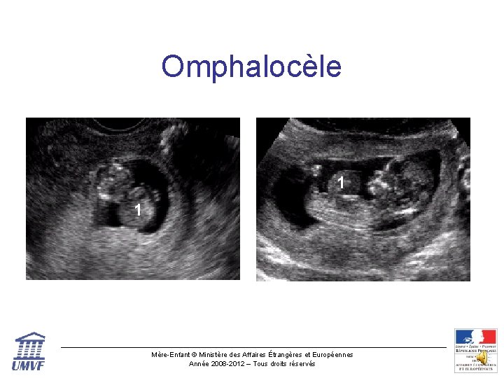 Omphalocèle 1 1 Mère-Enfant © Ministère des Affaires Étrangères et Européennes Année 2008 -2012
