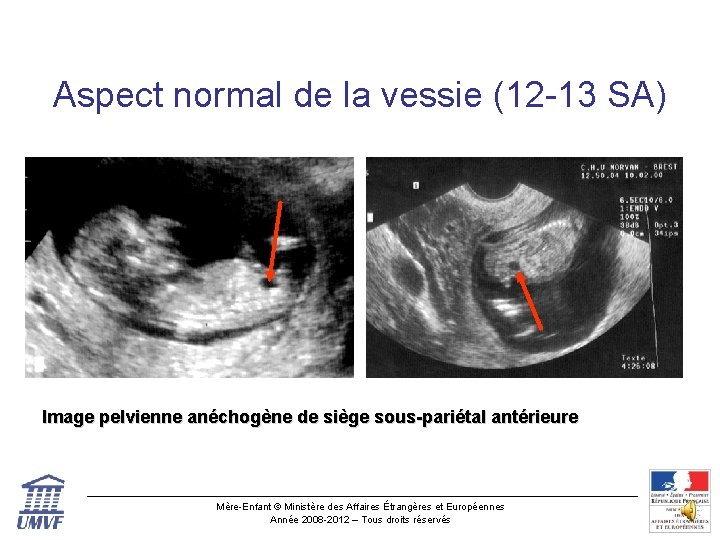 Aspect normal de la vessie (12 -13 SA) Image pelvienne anéchogène de siège sous-pariétal