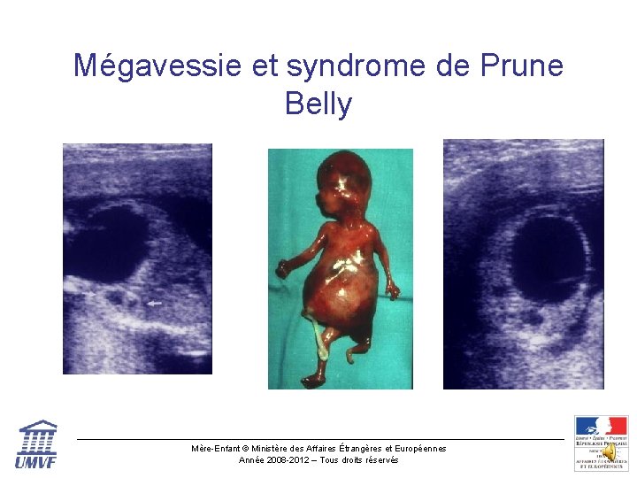 Mégavessie et syndrome de Prune Belly Mère-Enfant © Ministère des Affaires Étrangères et Européennes
