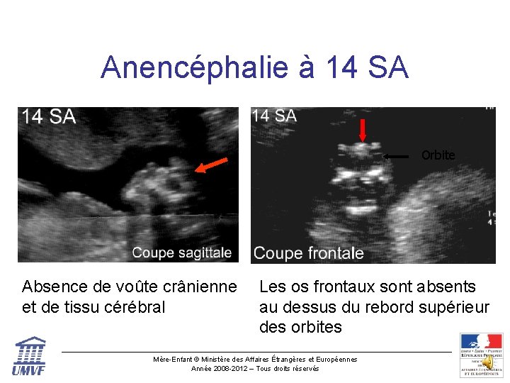 Anencéphalie à 14 SA Orbite Absence de voûte crânienne et de tissu cérébral Les