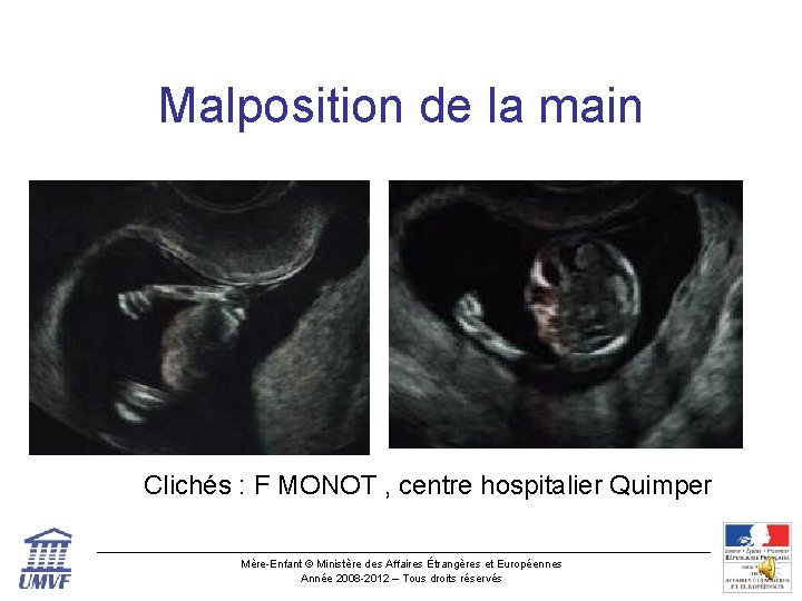 Malposition de la main Clichés : F MONOT , centre hospitalier Quimper Mère-Enfant ©