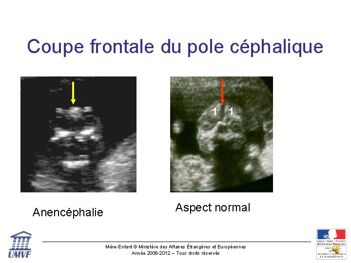 Coupe frontale du pole céphalique 1 Anencéphalie 1 Aspect normal Mère-Enfant © Ministère des