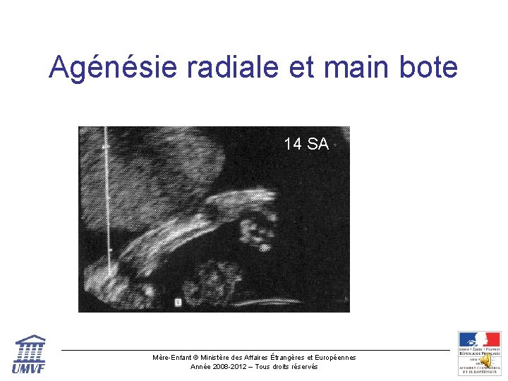 Agénésie radiale et main bote 14 SA Mère-Enfant © Ministère des Affaires Étrangères et