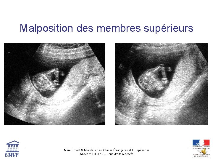 Malposition des membres supérieurs Mère-Enfant © Ministère des Affaires Étrangères et Européennes Année 2008