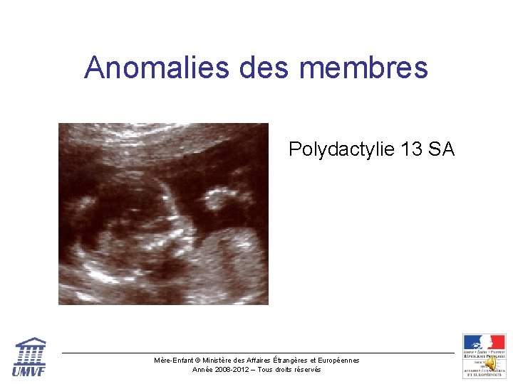 Anomalies des membres Polydactylie 13 SA Mère-Enfant © Ministère des Affaires Étrangères et Européennes