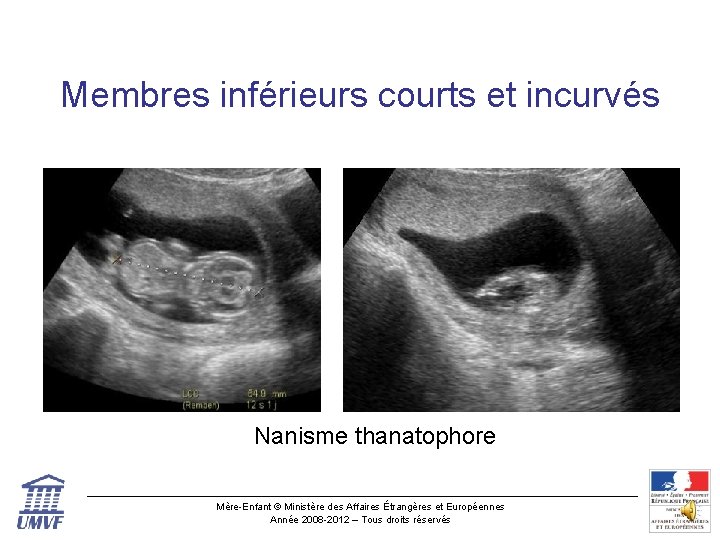 Membres inférieurs courts et incurvés Nanisme thanatophore Mère-Enfant © Ministère des Affaires Étrangères et