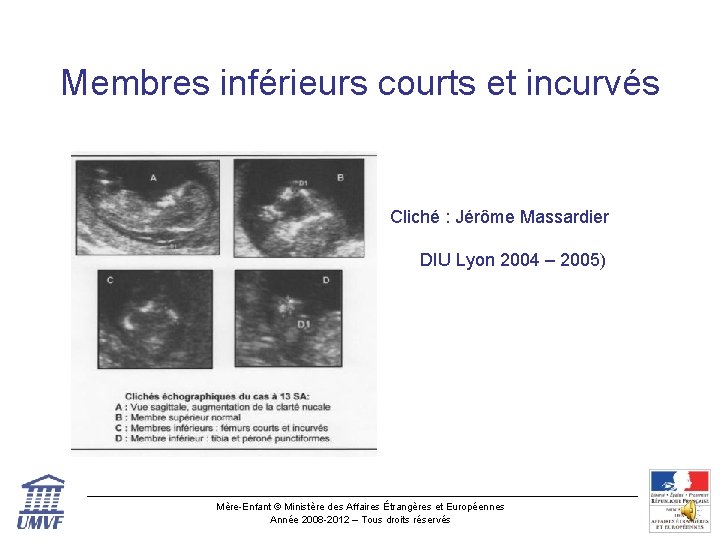 Membres inférieurs courts et incurvés Cliché : Jérôme Massardier DIU Lyon 2004 – 2005)