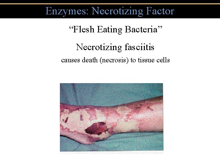 Enzymes: Necrotizing Factor “Flesh Eating Bacteria” Necrotizing fasciitis causes death (necrosis) to tissue cells Enzymes: Necrotizing Factor “Flesh Eating Bacteria” Necrotizing fasciitis causes death (necrosis) to tissue cells