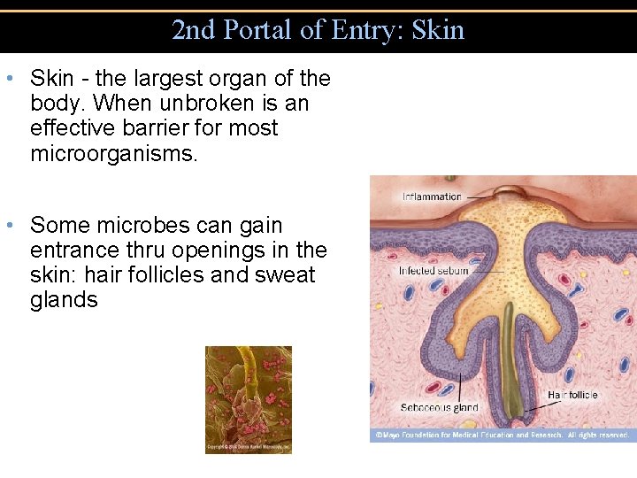 2 nd Portal of Entry: Skin • Skin - the largest organ of the