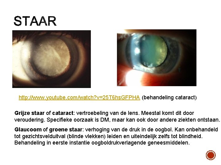 http: //www. youtube. com/watch? v=25 T 6 hs. GFPHA (behandeling cataract) Grijze staar of